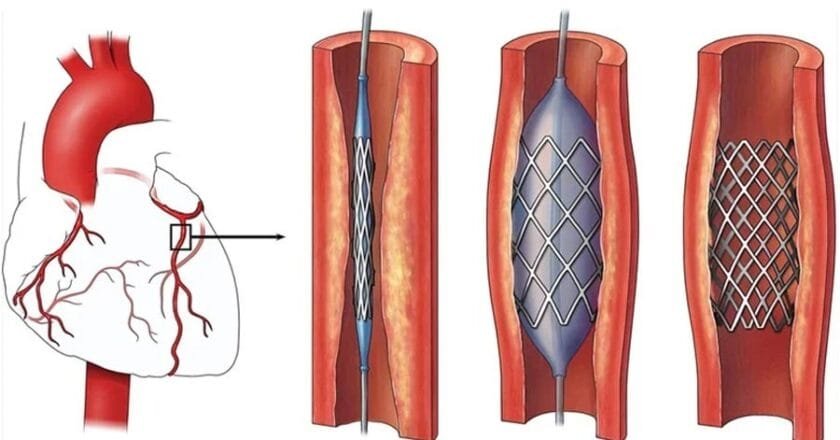 প্রযুক্তির এক বিস্ময়কর যন্ত্রাংশ ‘হার্টের রিং’