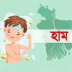 হাম ও উপসর্গ নিয়ে আরও ৫ শিশুর মৃত্যু