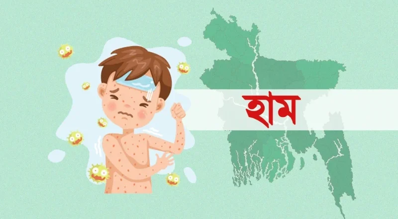 হাম ও উপসর্গ নিয়ে আরও ৫ শিশুর মৃত্যু