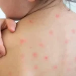 হামে আক্রান্ত ৭৪ শতাংশ শিশুই ছিল টিকার বাইরে: স্বাস্থ্য অধিদপ্তর