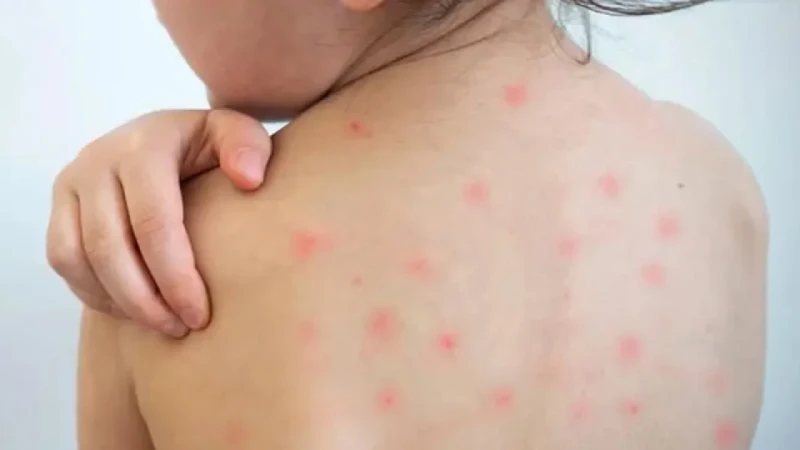 হামে আক্রান্ত ৭৪ শতাংশ শিশুই ছিল টিকার বাইরে: স্বাস্থ্য অধিদপ্তর